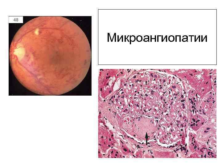 Микроангиопатии 