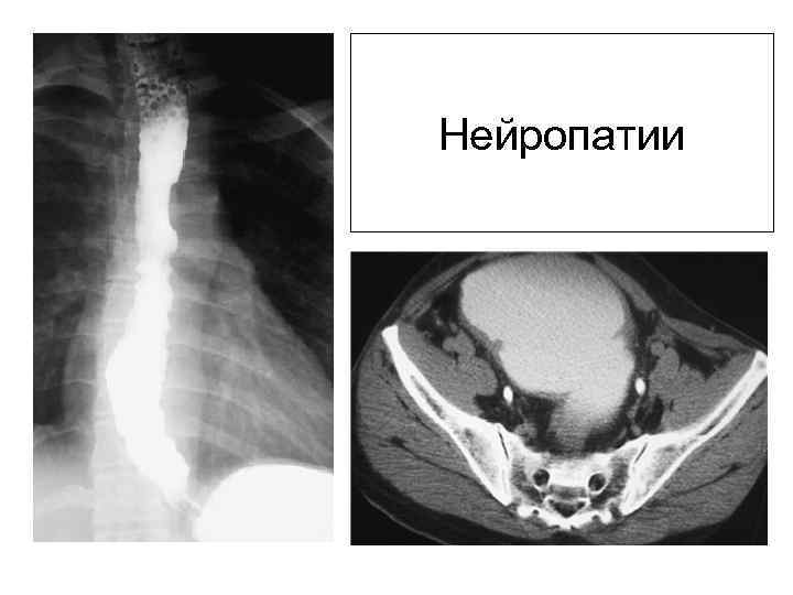 Нейропатии 