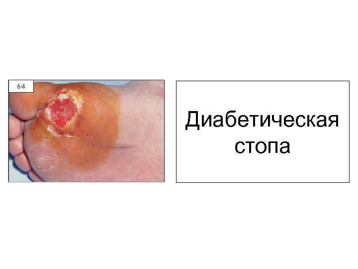 Диабетическая стопа 