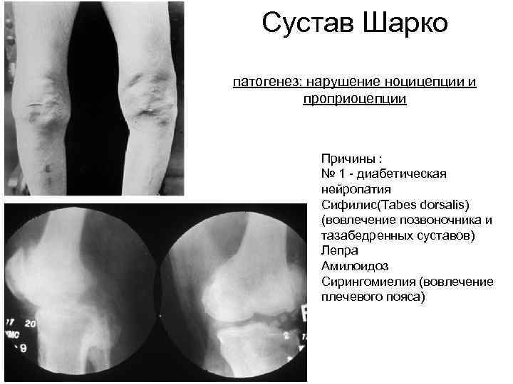 Cустав Шарко патогенез: нарушение ноцицепции и проприоцепции Причины : № 1 - диабетическая нейропатия