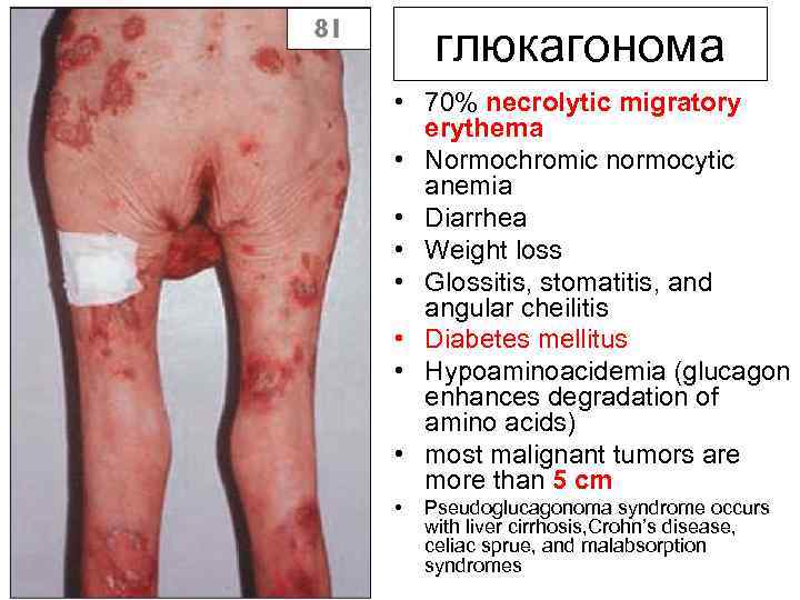 глюкагонома • 70% necrolytic migratory erythema • Normochromic normocytic anemia • Diarrhea • Weight
