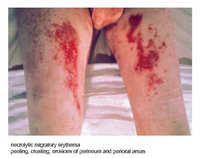 necrolytic migratory erythema peeling, crusting, erosions of perineum and perioral areas 