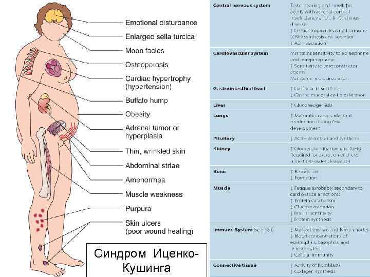 Синдром Иценко. Кушинга 