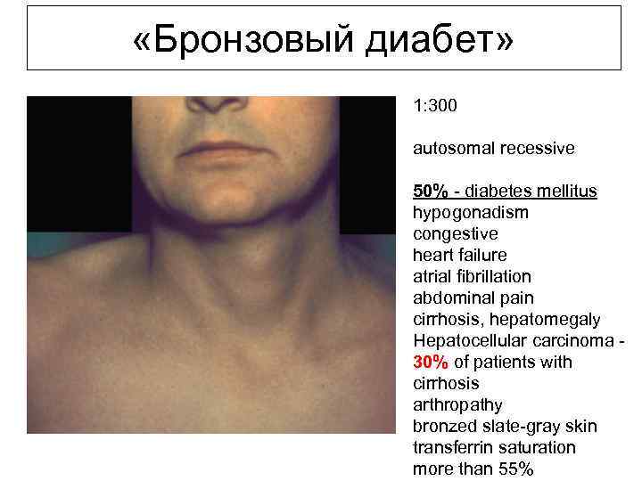  «Бронзовый диабет» 1: 300 autosomal recessive 50% - diabetes mellitus hypogonadism congestive heart