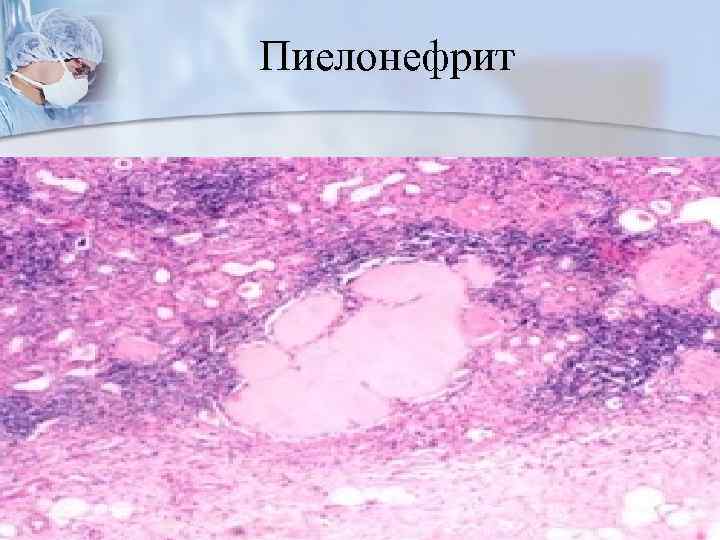 Пиелонефрит 