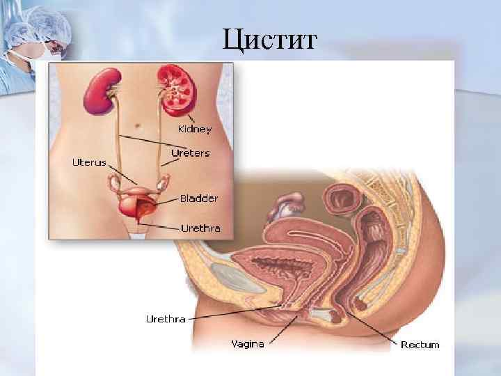 Цистит 