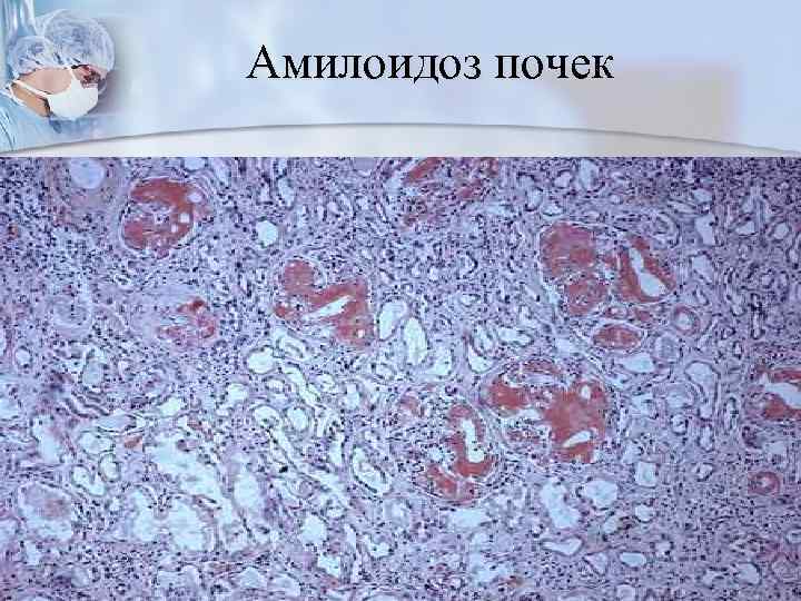 Амилоидоз почек 