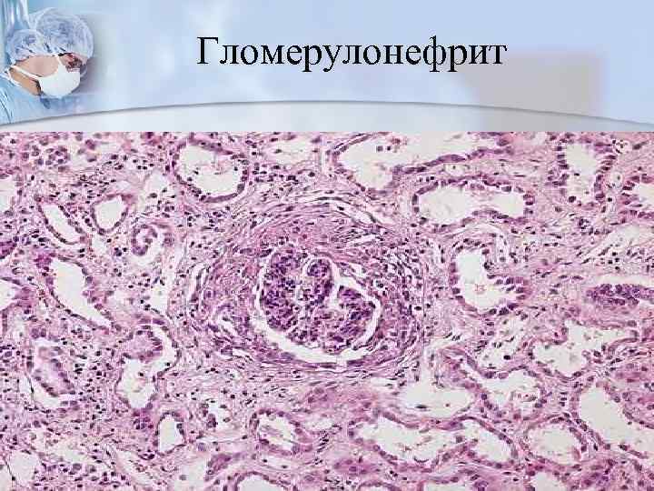 Гломерулонефрит 