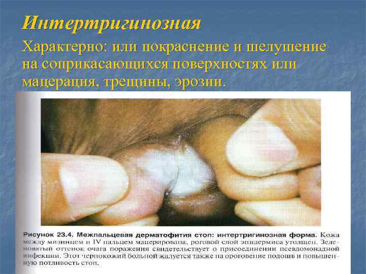 Интертригинозная Характерно: или покраснение и шелушение на соприкасающихся поверхностях или мацерация, трещины, эрозии. 