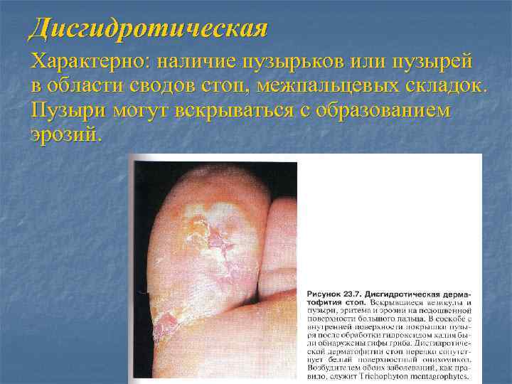 Дисгидротическая Характерно: наличие пузырьков или пузырей в области сводов стоп, межпальцевых складок. Пузыри могут