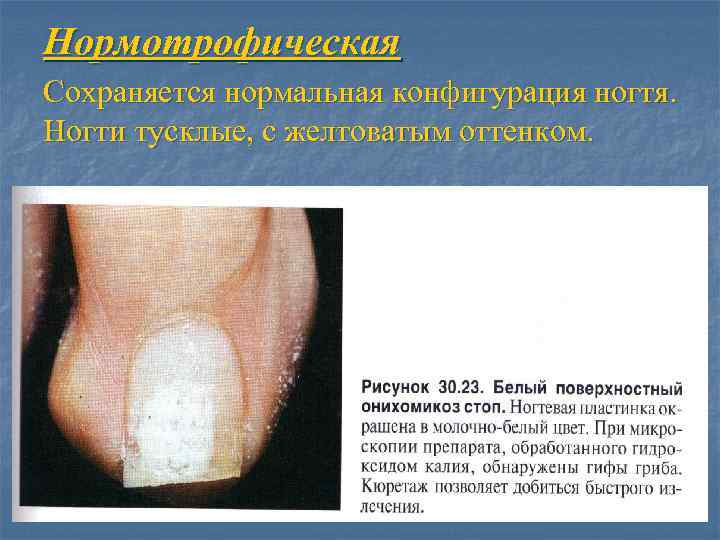 Нормотрофическая Сохраняется нормальная конфигурация ногтя. Ногти тусклые, с желтоватым оттенком. 