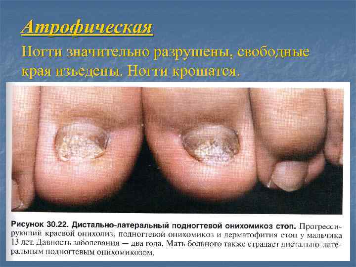Атрофическая Ногти значительно разрушены, свободные края изъедены. Ногти крошатся. 