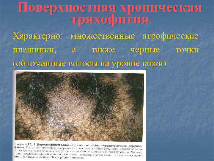 Поверхностная хроническая  трихофития Характерно: множественные атрофические плешинки, а  также  черные 
