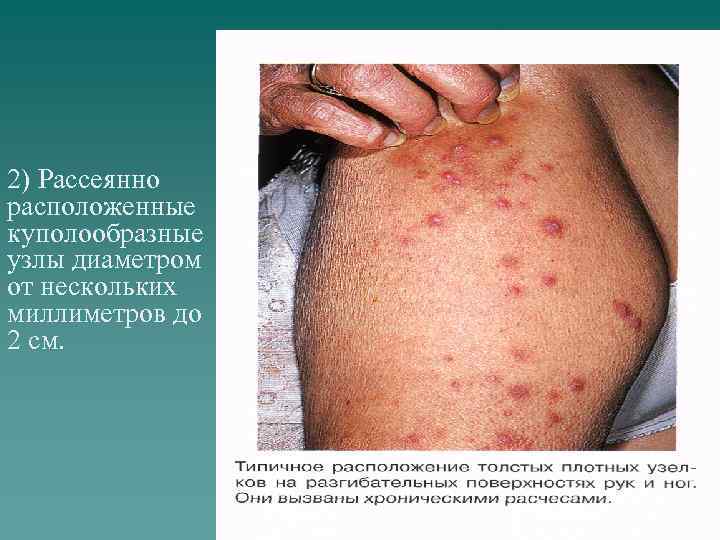 2) Рассеянно расположенные куполообразные узлы диаметром от нескольких миллиметров до 2 см. 