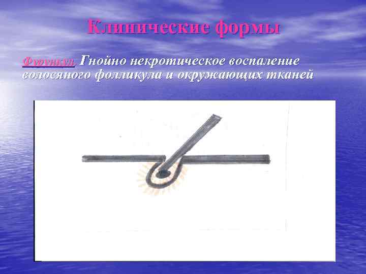   Клинические формы Фурункул. Гнойно некротическое воспаление волосяного фолликула и окружающих тканей