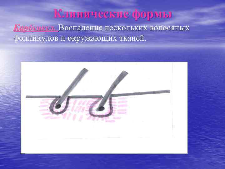    Клинические формы Карбункул. Воспаление нескольких волосяных фолликулов и окружающих тканей. 