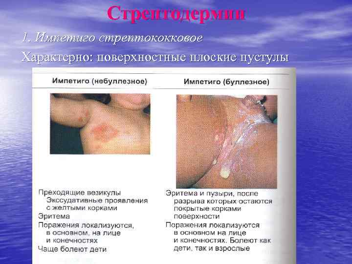    Стрептодермии 1. Импетиго стрептококковое Характерно: поверхностные плоские пустулы 