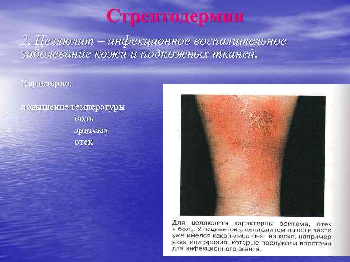    Стрептодермии 2. Целлюлит – инфекционное воспалительное заболевание кожи и подкожных тканей.