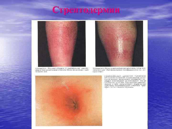 Стрептодермии 