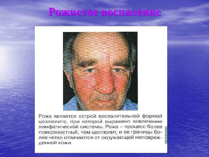 Рожистое воспаление 