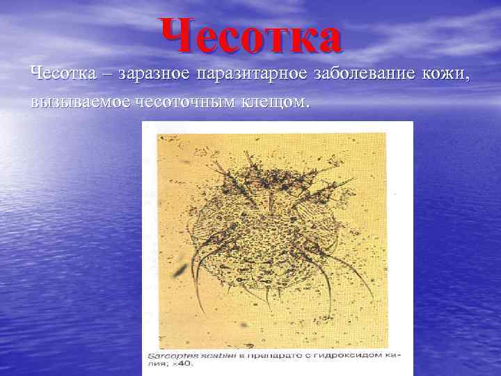    Чесотка – заразное паразитарное заболевание кожи, вызываемое чесоточным клещом. 