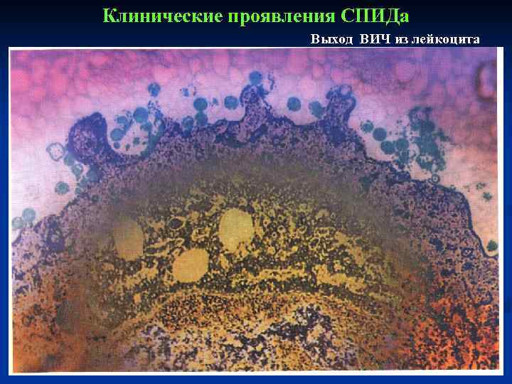 Клинические проявления СПИДа    Выход ВИЧ из лейкоцита 