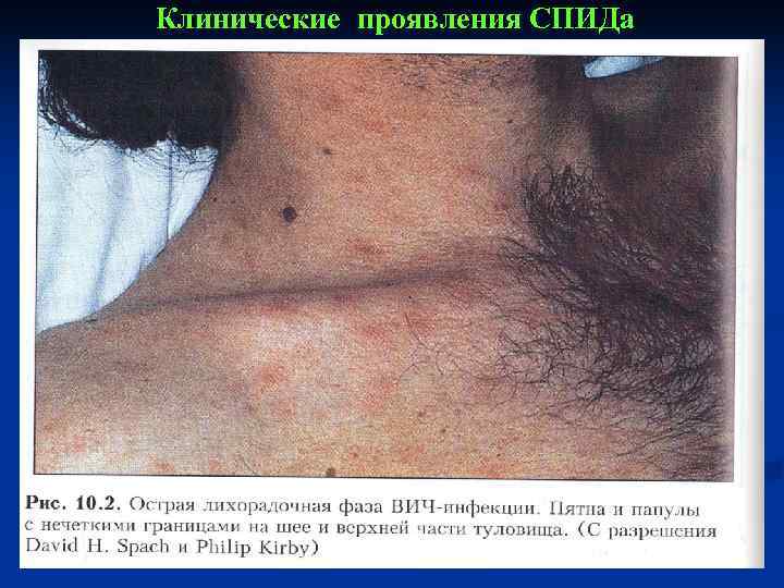 Клинические проявления СПИДа 
