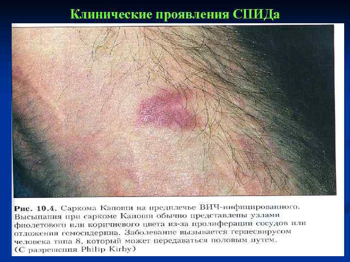 Клинические проявления СПИДа 