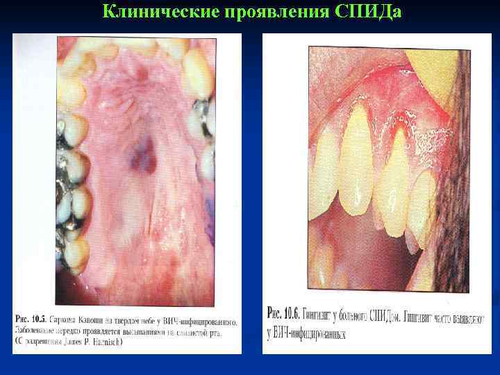 Клинические проявления СПИДа 