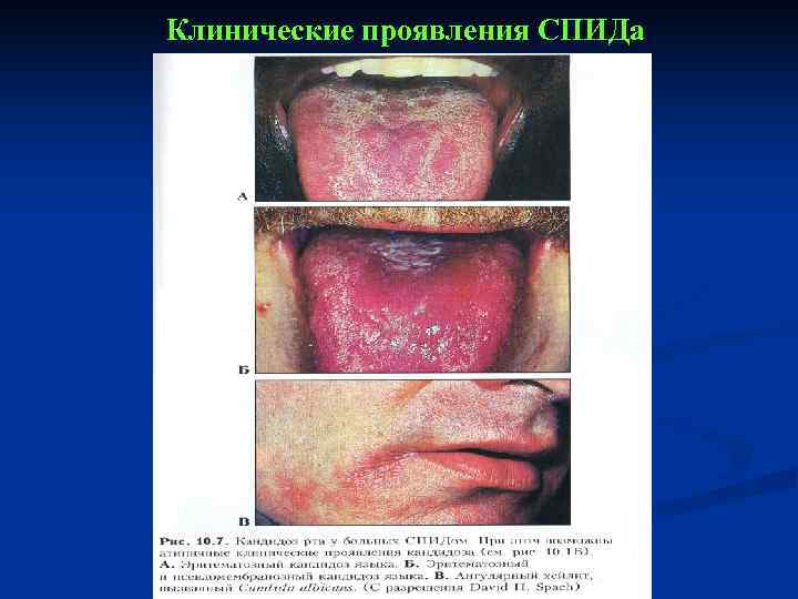 Клинические проявления СПИДа 