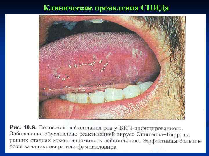 Клинические проявления СПИДа 