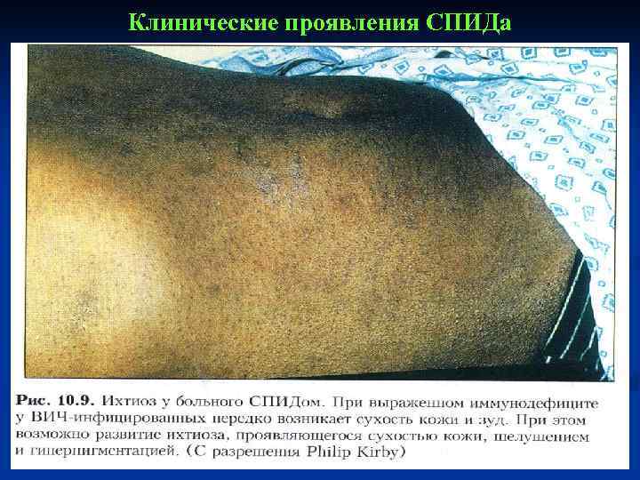 Клинические проявления СПИДа 