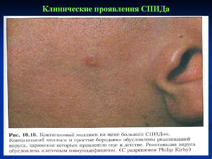 Клинические проявления СПИДа 