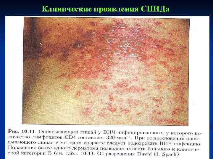 Клинические проявления СПИДа 