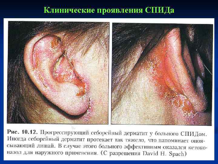 Клинические проявления СПИДа 