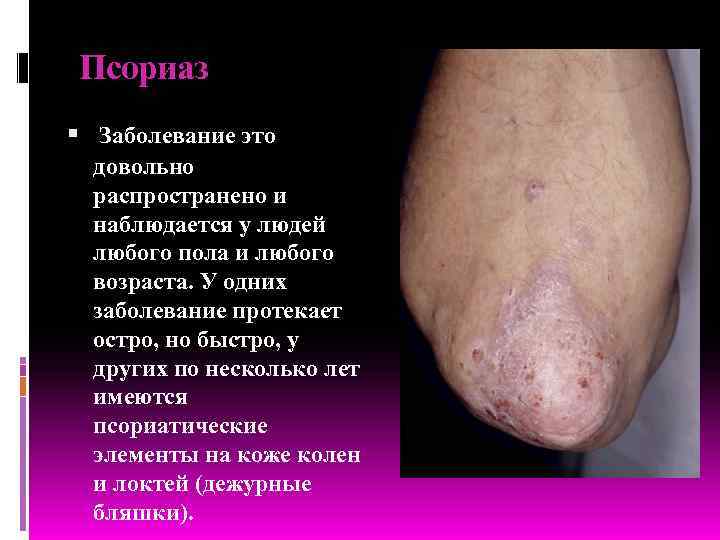  Псориаз  Заболевание это  довольно  распространено и  наблюдается у людей