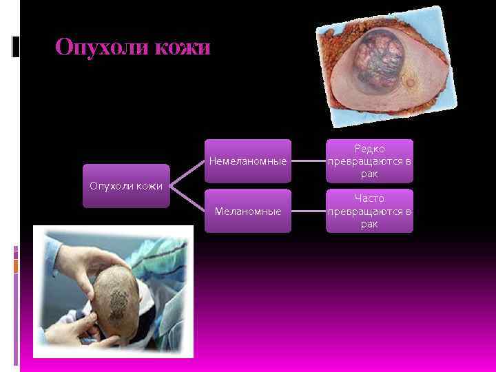 Опухоли кожи    Редко   Немеланомные  превращаются в  