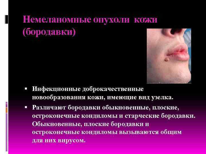 Немеланомные опухоли кожи (бородавки)  Инфекционные доброкачественные  новообразования кожи, имеющие вид узелка. 