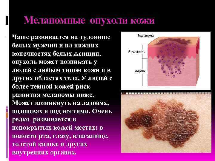  Меланомные опухоли кожи  Чаще развивается на туловище  белых мужчин и на