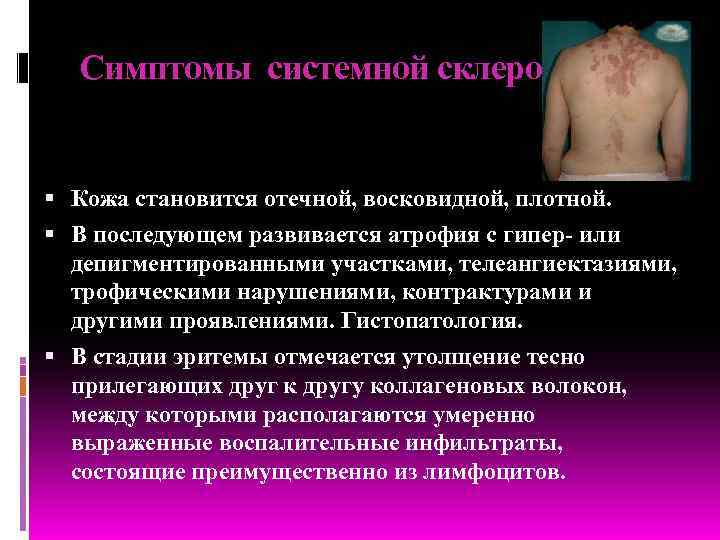  Симптомы системной склеродермии Кожа становится отечной, восковидной, плотной.  В последующем развивается атрофия