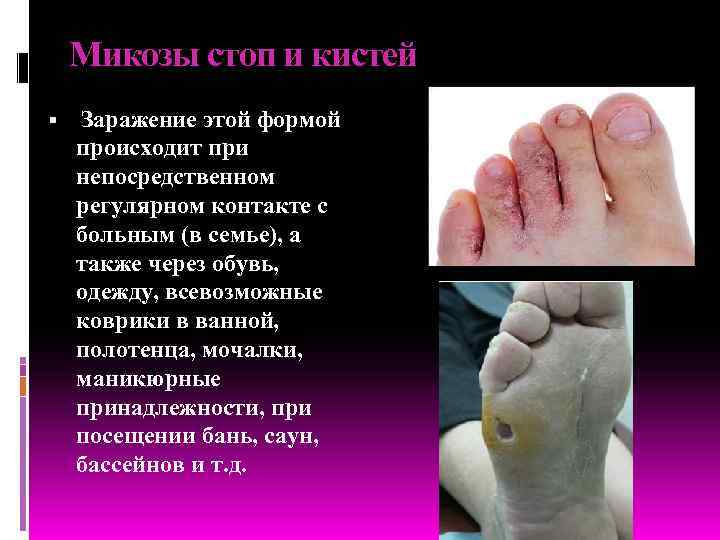   Микозы стоп и кистей Заражение этой формой происходит при непосредственном регулярном контакте