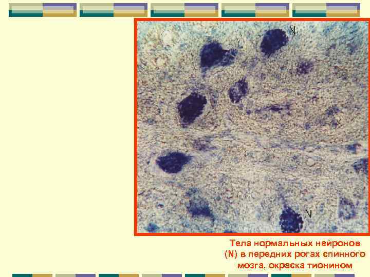  Тела нормальных нейронов (N) в передних рогах спинного  мозга, окраска тионином 