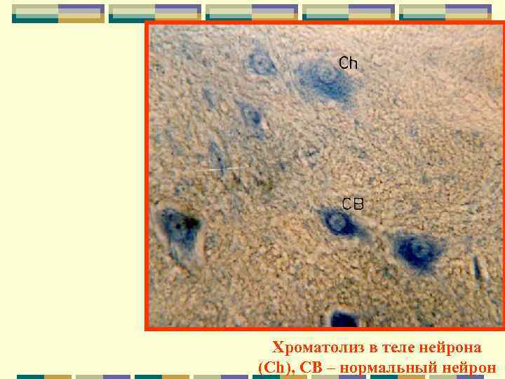  Хроматолиз в теле нейрона (Ch), CB – нормальный нейрон 
