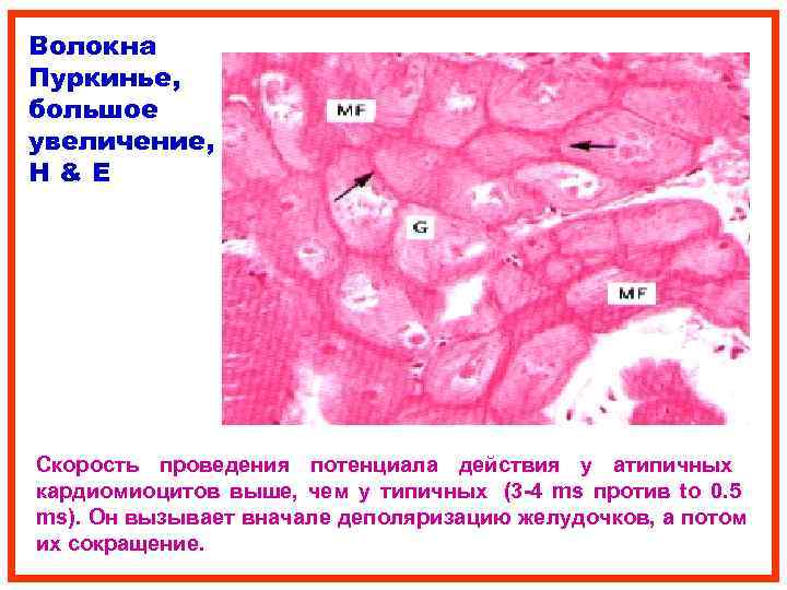 Волокна Пуркинье, большое увеличение, H&E Скорость проведения потенциала действия у атипичных кардиомиоцитов выше, чем