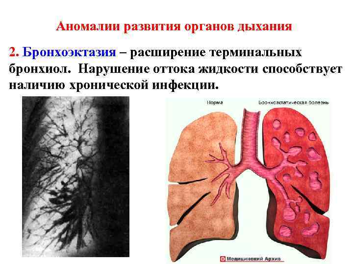 Врожденные пороки развития дыхательной системы презентация