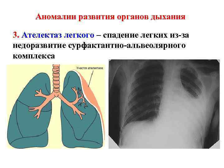 Врожденные пороки развития дыхательной системы презентация