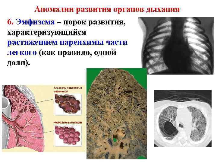 Пороки развития дыхательной системы презентация