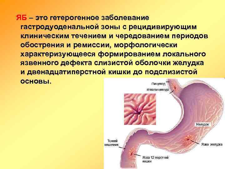  ЯБ – это гетерогенное заболевание гастродуоденальной зоны с рецидивирующим клиническим течением и чередованием