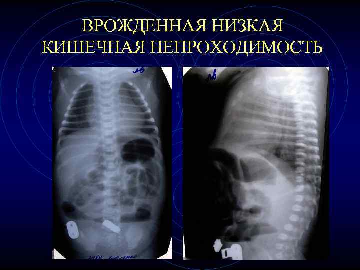 ВРОЖДЕННАЯ НИЗКАЯ КИШЕЧНАЯ НЕПРОХОДИМОСТЬ ВРОЖДЕННАЯ НИЗКАЯ КИШЕЧНАЯ НЕПРОХОДИМОСТЬ