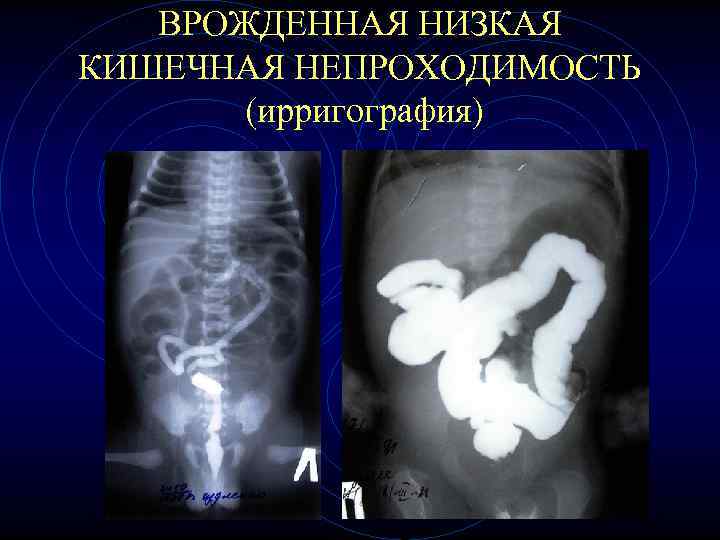 ВРОЖДЕННАЯ НИЗКАЯ КИШЕЧНАЯ НЕПРОХОДИМОСТЬ (ирригография) ВРОЖДЕННАЯ НИЗКАЯ КИШЕЧНАЯ НЕПРОХОДИМОСТЬ (ирригография)